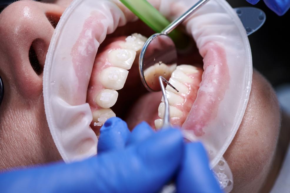 Antibiyotikle Geçmeyen Diş Eti İltihabı