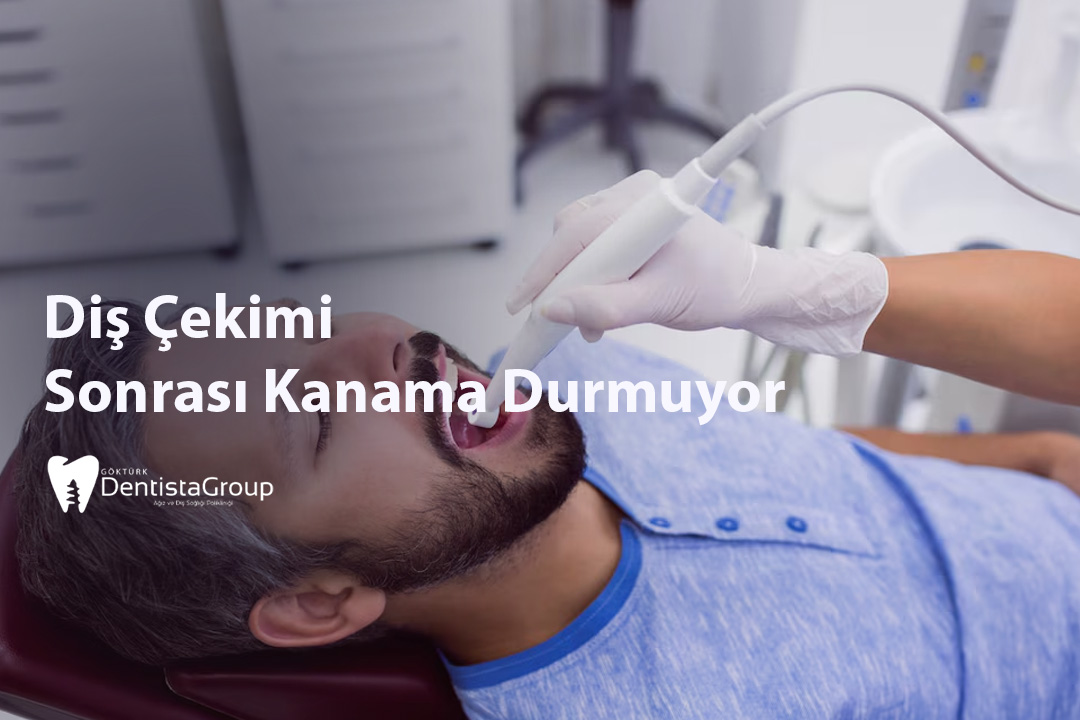 Diş Çekimi Sonrası Kanama Durmuyor